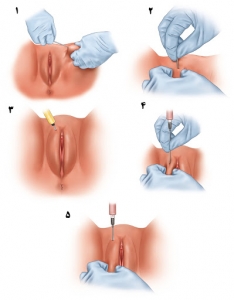تزریق چربی به واژن