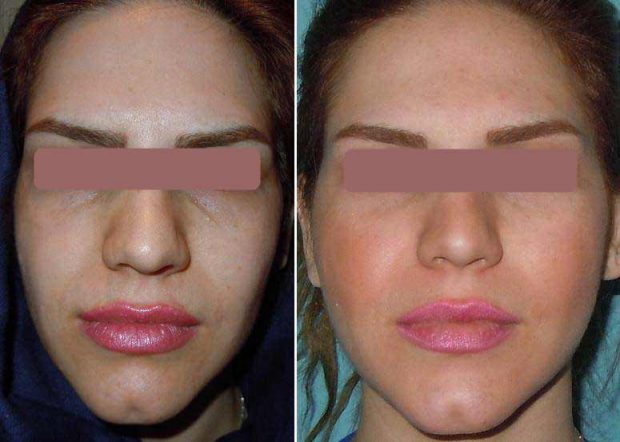 تزریق چربی گونه به روش بایوفت