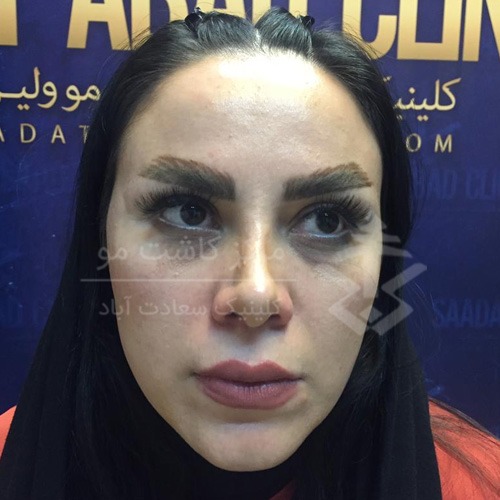 اصلاح صورت با تزریق چربی