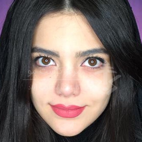 تزریق چربی به بدن و صورت