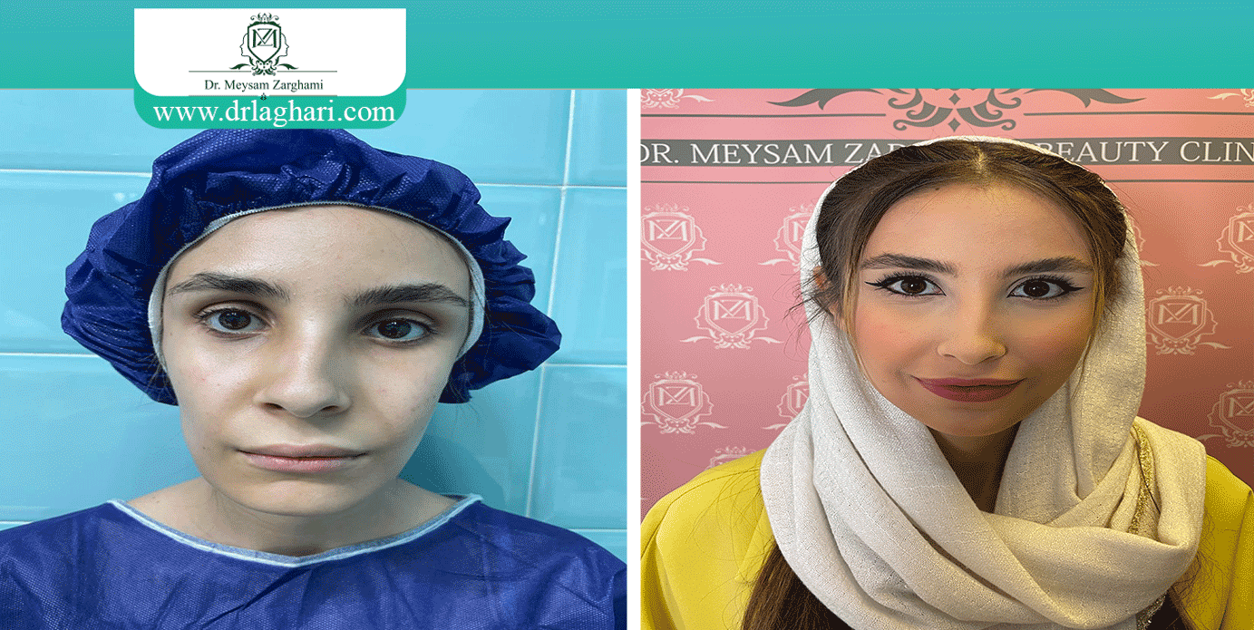 تزریق گونه بایوفت برای صورت کشیده