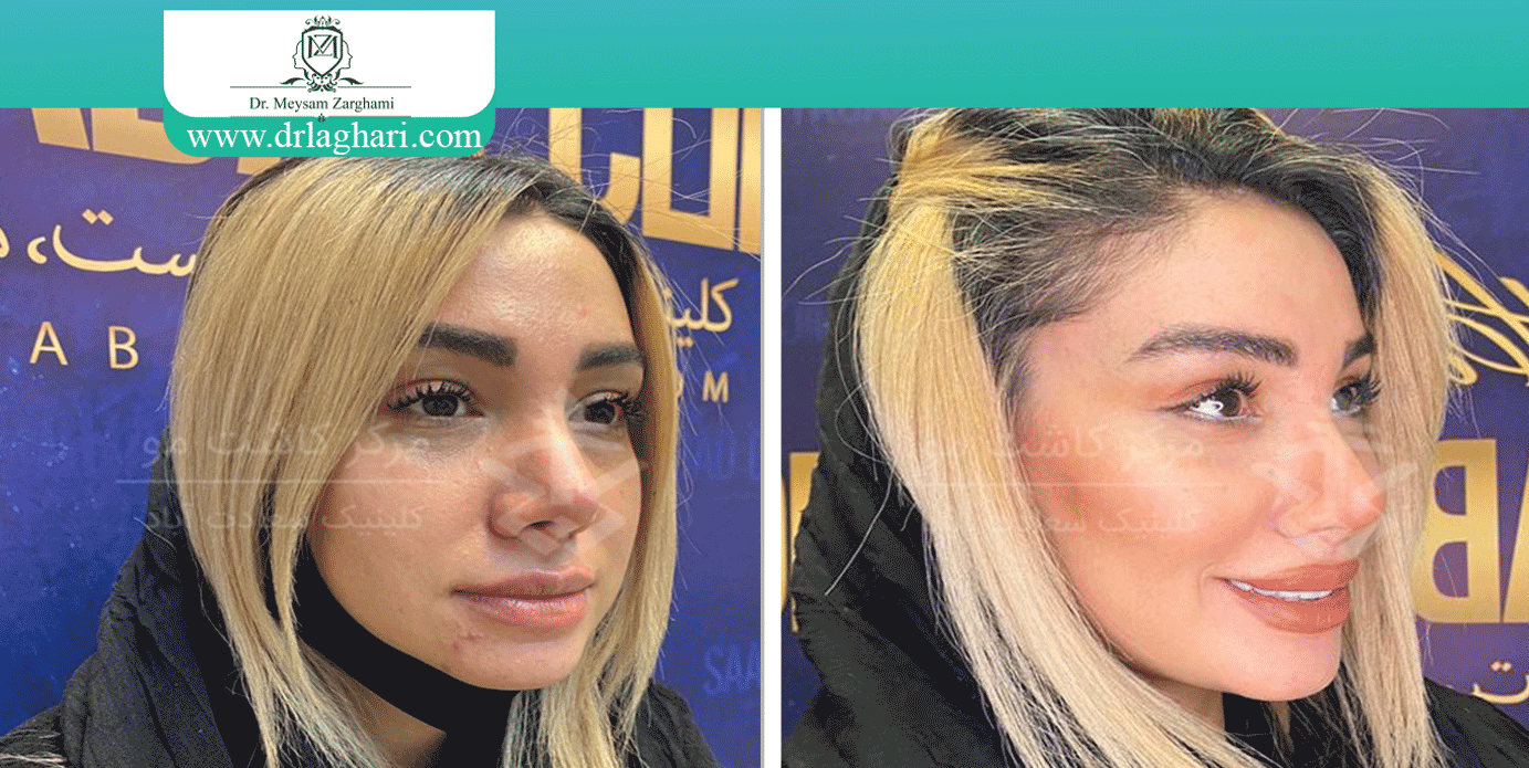 تزریق چربی زیر پوست صورت
