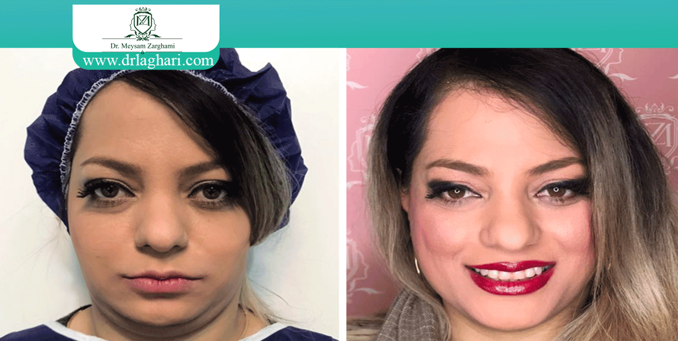 بهترین تزریق چربی در اصفهان