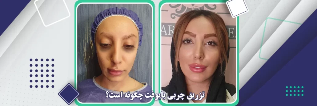 تزریق چربی بایوفت چگونه است؟