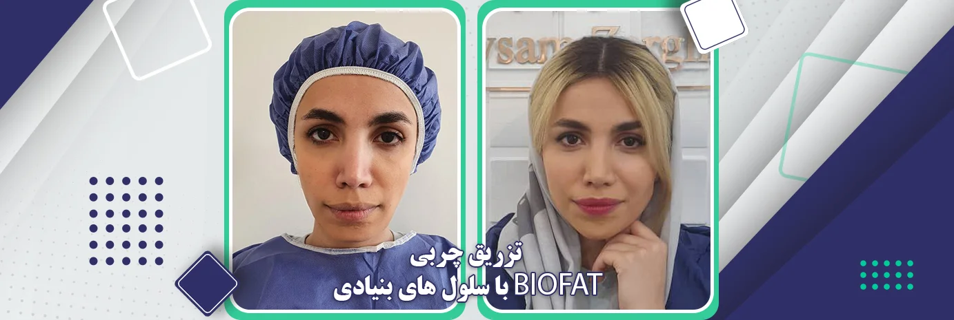 تزریق چربی با سلول های بنیادی BIOFAT