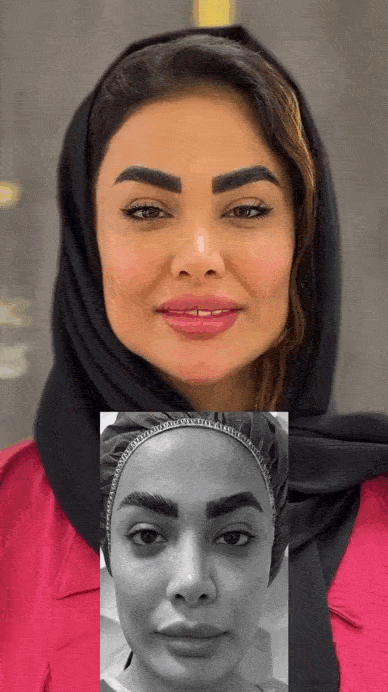 هزینه تزریق چربی در سال