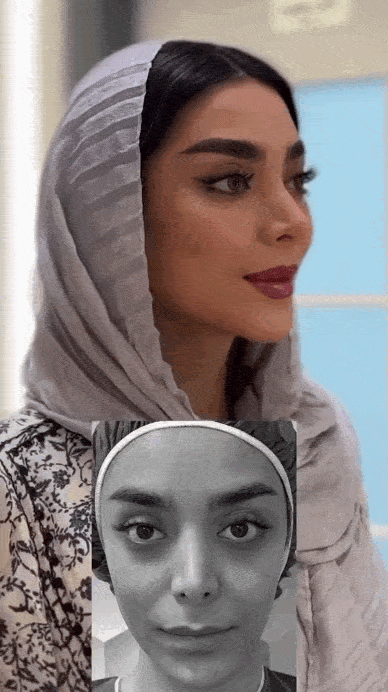 دوره نقاهت تزریق چربی صورت