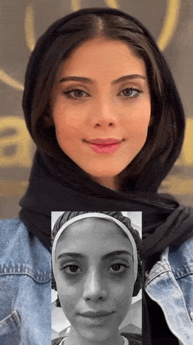 برای جلوگیری از کبودی بعد از تزریق ژل چه کنیم؟