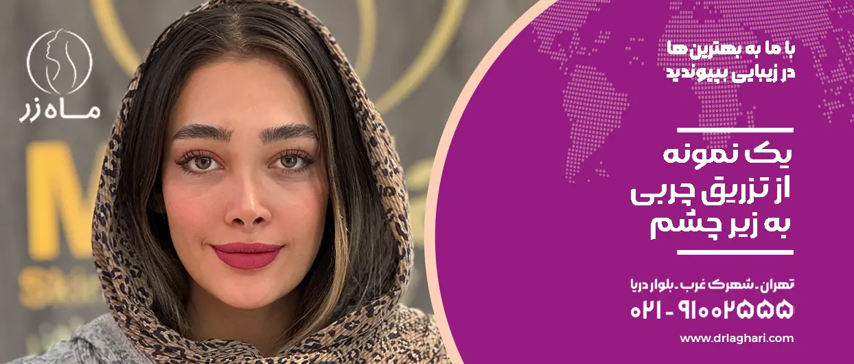 فواید تزریق چربی به زیر چشم