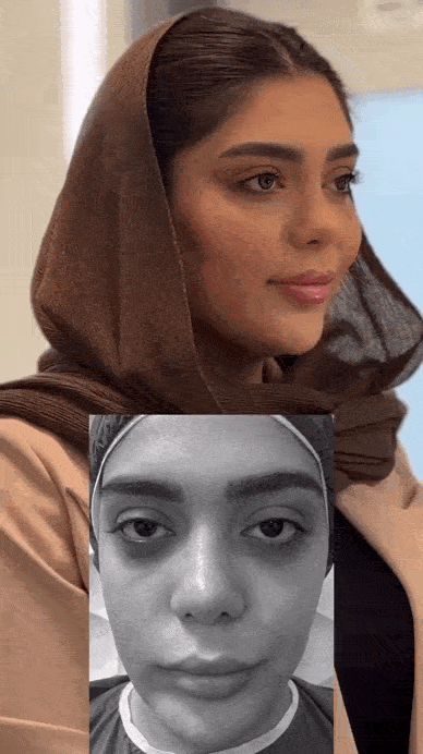 هزینه تزریق چربی به گونه