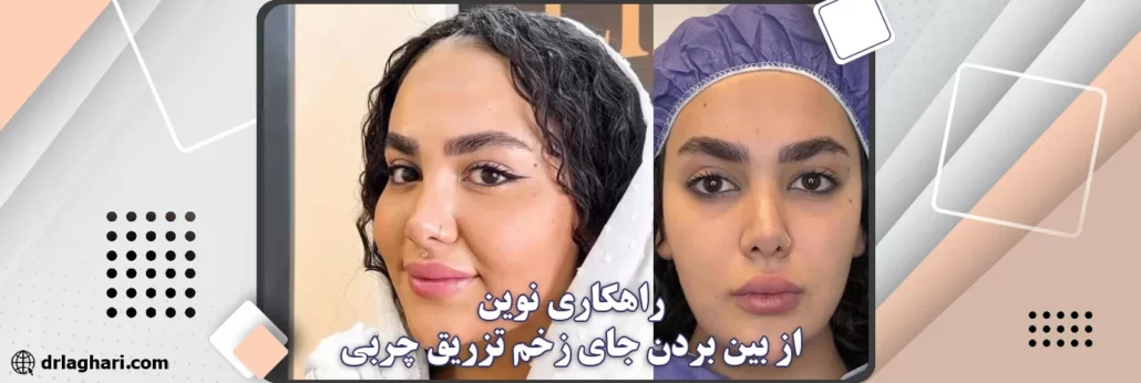 جای زخم تزریق چربی