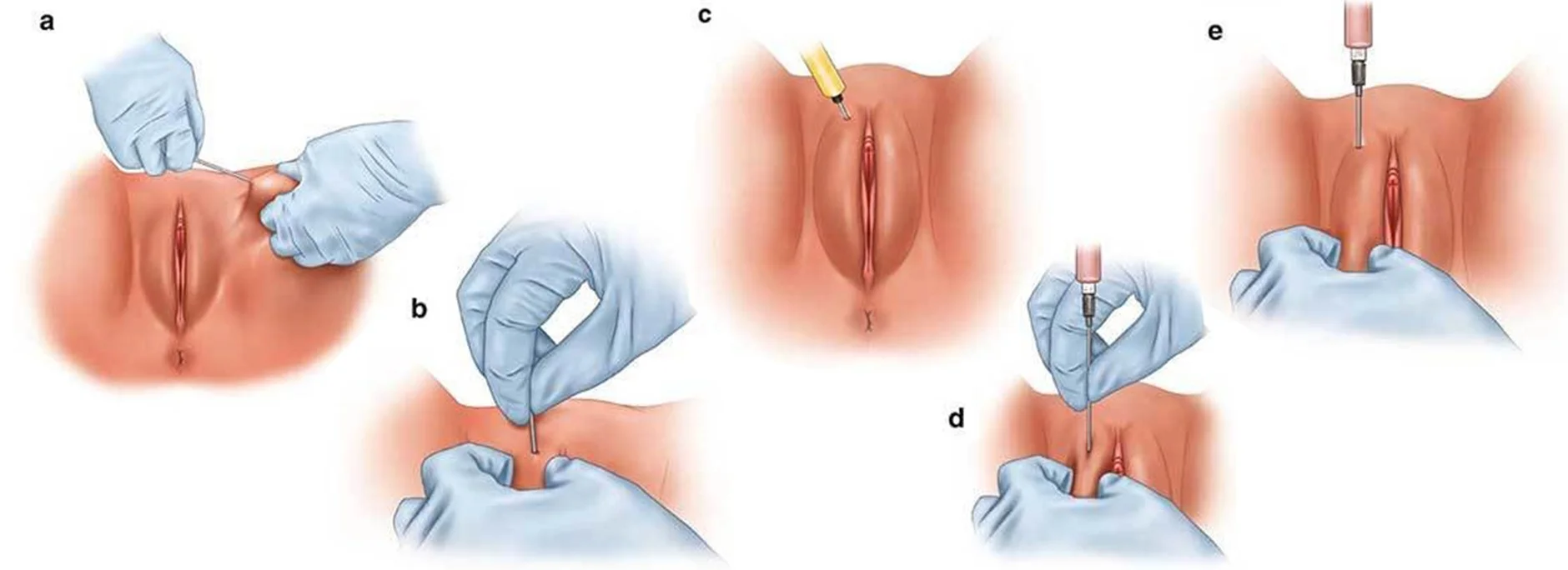 عوارض تزریق چربی به واژن