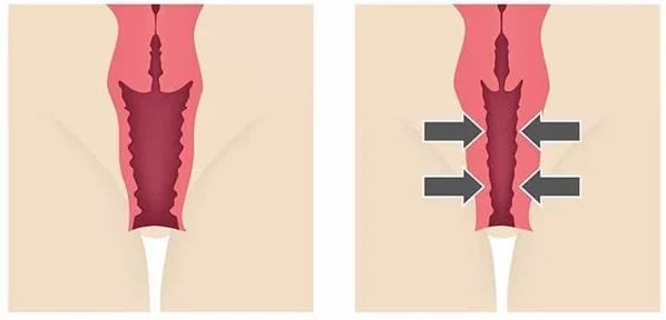 مزایای تزریق چربی به واژن چیست؟