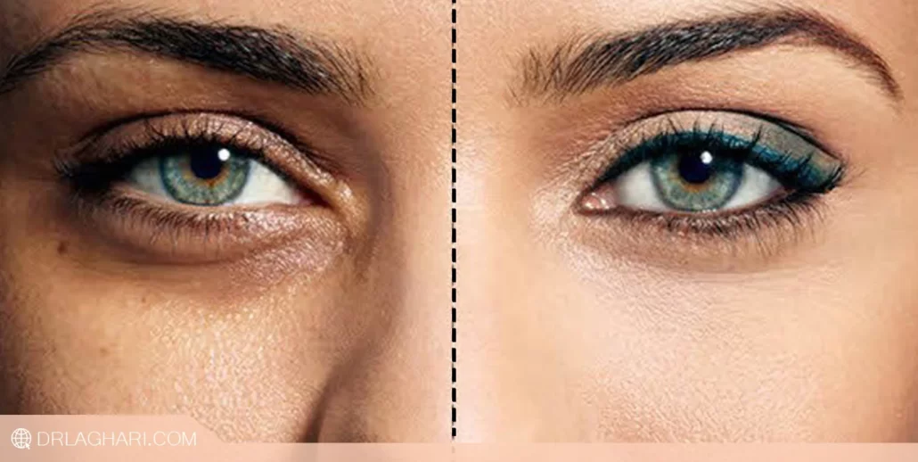 قبل و بعد تزریق ژل برای رفع گودی زیر چشم