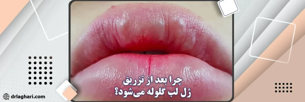 چرا بعد از تزریق ژل لب گلوله می_شود؟