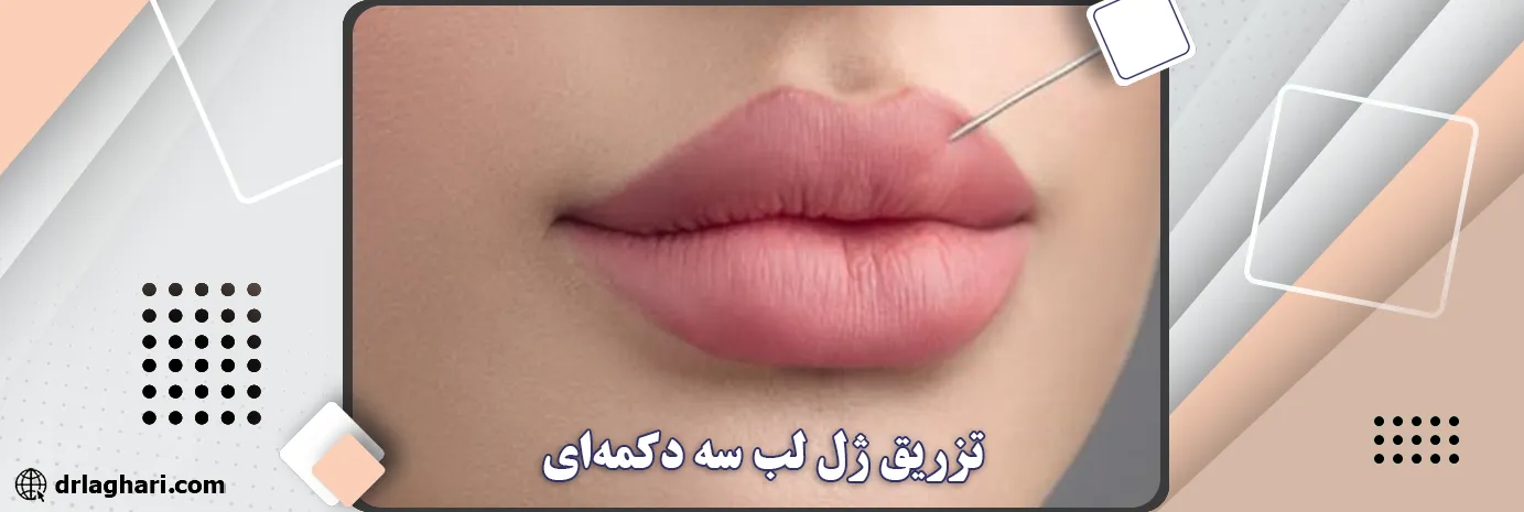 تزریق ژل لب سه دکمه‌ای