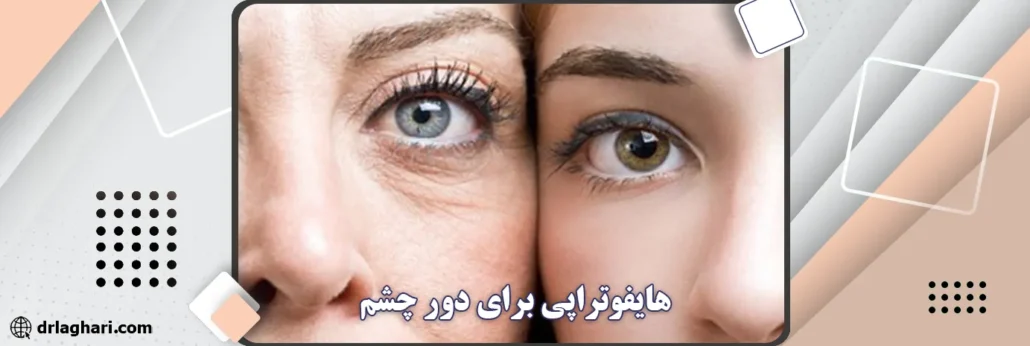 هایفوتراپی برای دور چشم