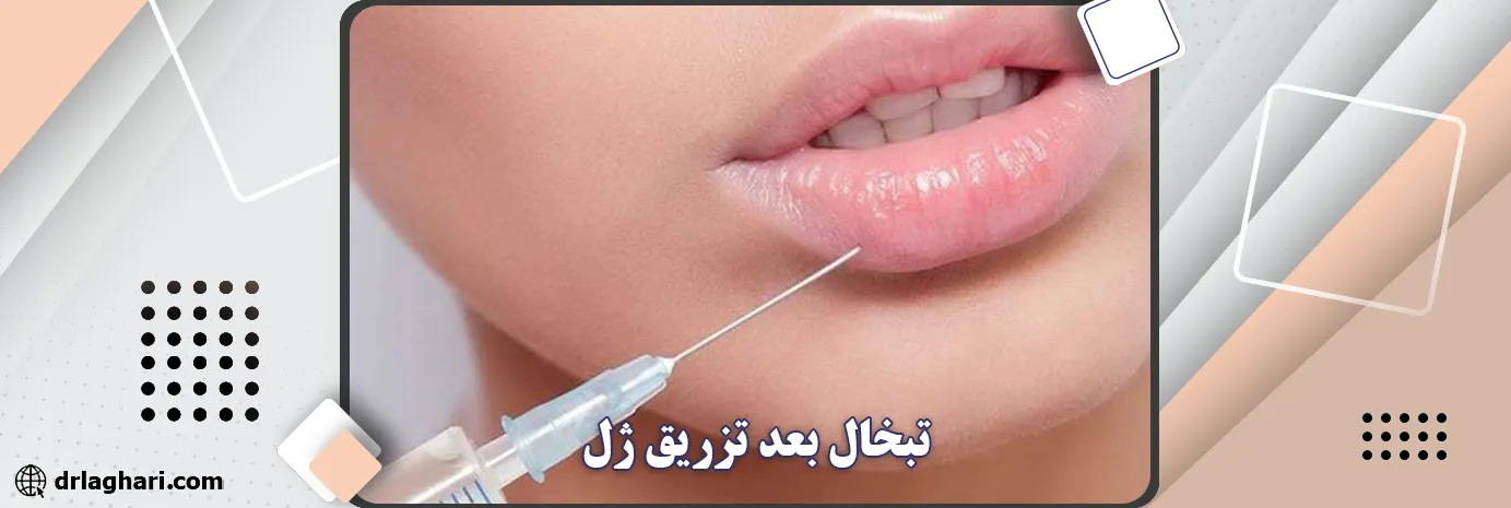 تبخال بعد تزریق ژل