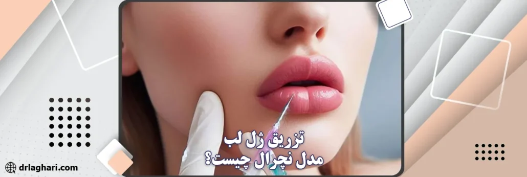 تزریق ژل لب مدل نچرال