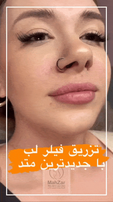 تزریق ژل لب مدل نچرال
