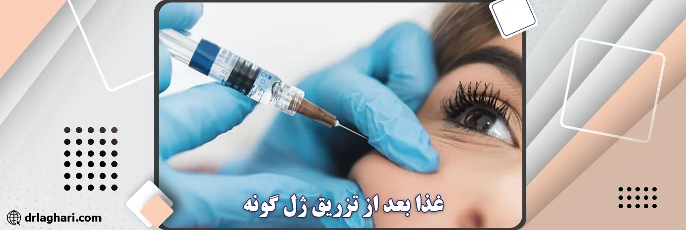 غذا بعد از تزریق ژل گونه