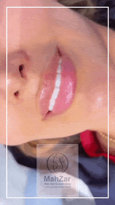 ژل لب با یک سی سی در کلینیک دکتر لاغری