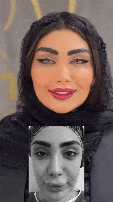  تزریق چربی به چانه