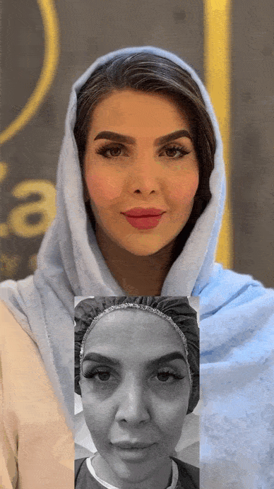 ایجاد تقارن در صورت با تزریق چربی