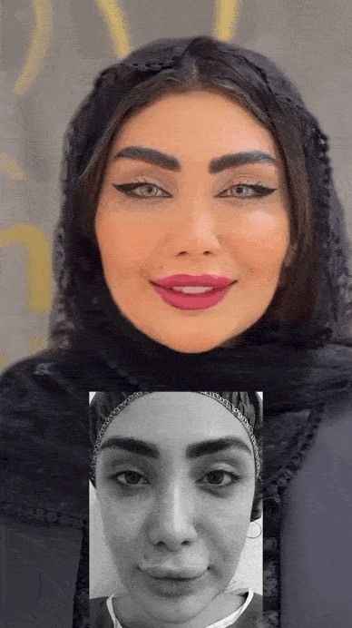 تزریق چربی دائمی با دوام بالا