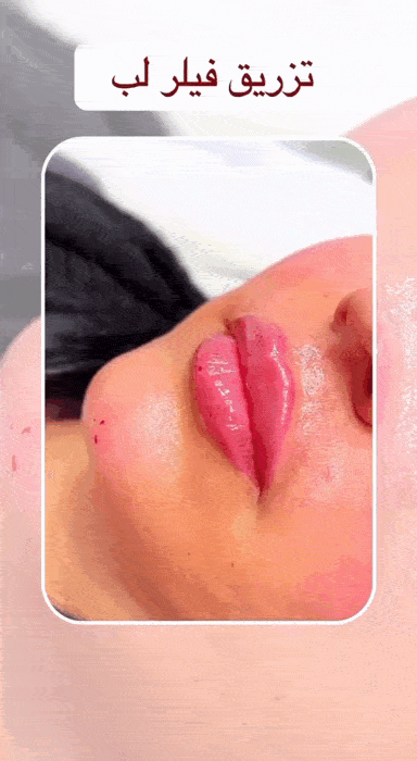 روش رفع افتادگی گوشه لب با ژل