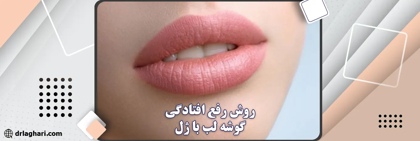 روش رفع افتادگی گوشه لب با ژل چیست؟