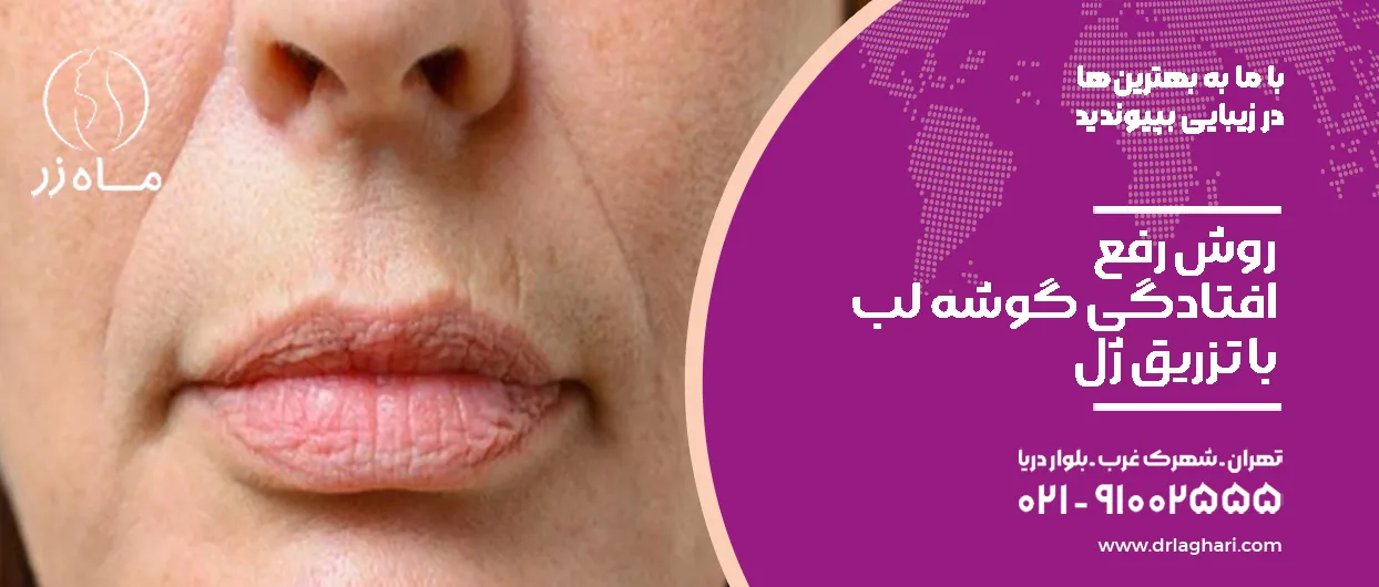 روش رفع افتادگی گوشه لب با ژل