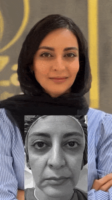 زاویه سازی و ایجاد خط فک با تزریق ژل