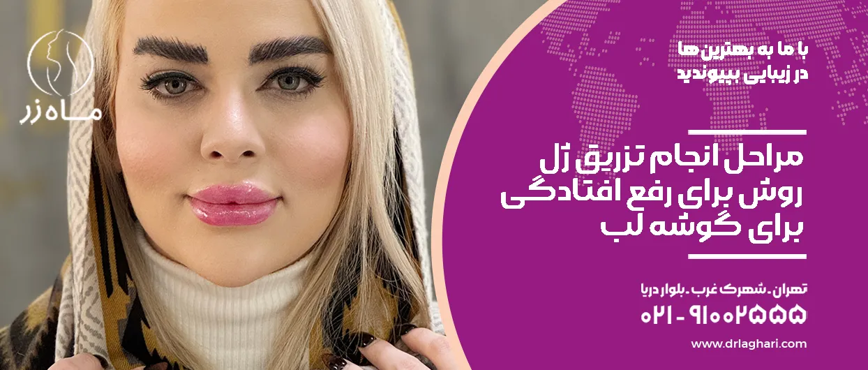 مراحل انجام تزریق ژل روش برای رفع افتادگی گوشه لب