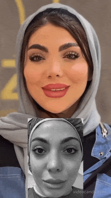 هزینه قرینه سازی صورت با تزریق چربی