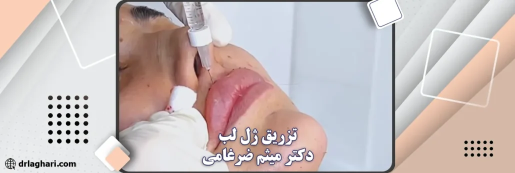 تزریق ژل لب دکتر میثم ضرغامی