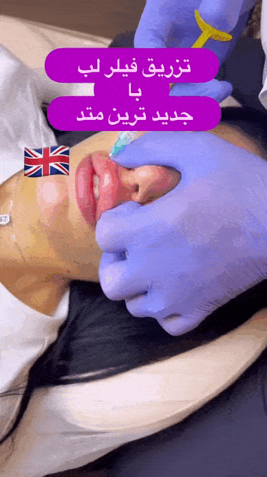 تزریق ژل لب دکتر میثم ضرغامی