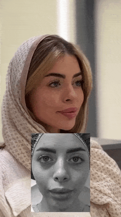 خط گونه با تزریق چربی