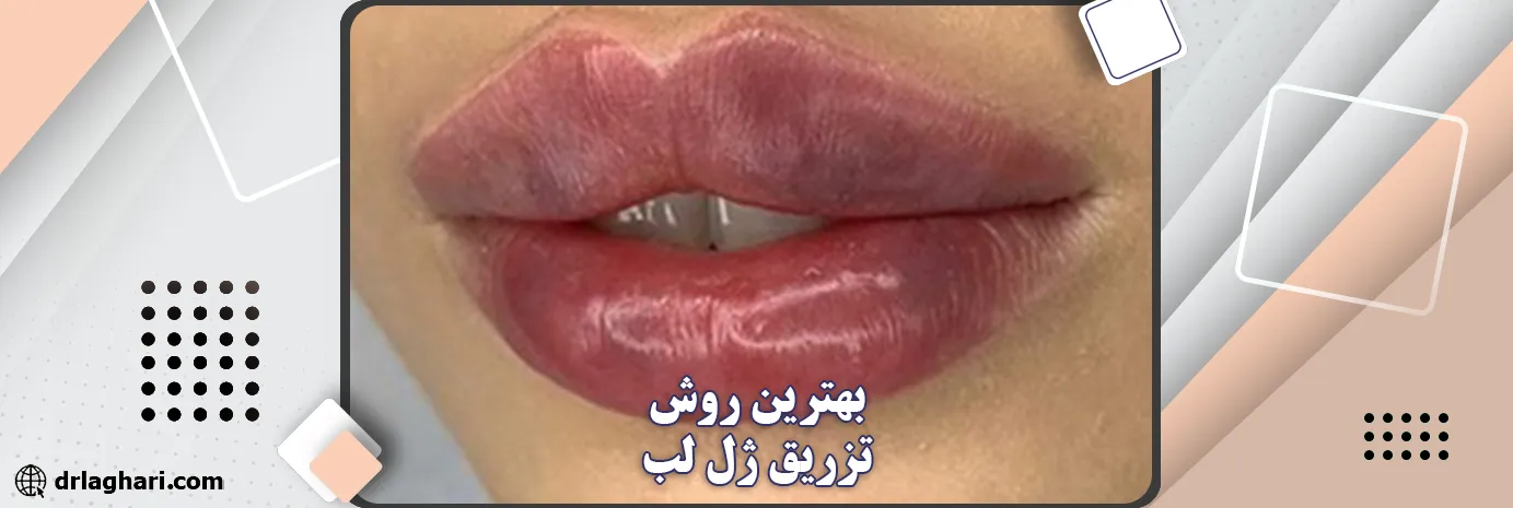 بهترین روش تزریق ژل لب
