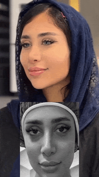 تزریق چربی برای رفع گودی چشم