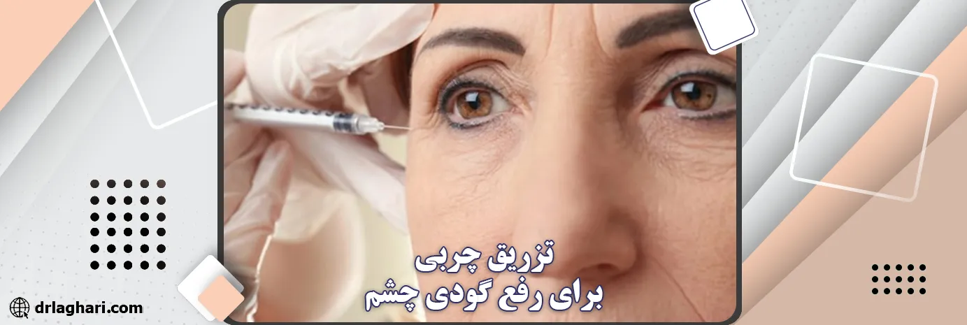 تزریق چربی برای رفع گودی چشم