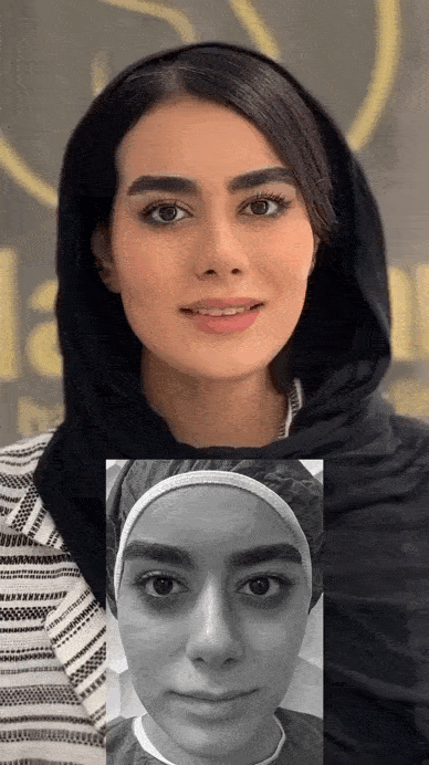 بهترین روش تزریق ژل خط خنده
