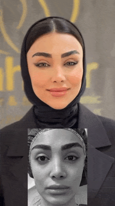 ماندگاری تزریق چربی بایوفت از ۱ سال بیشتر است؟