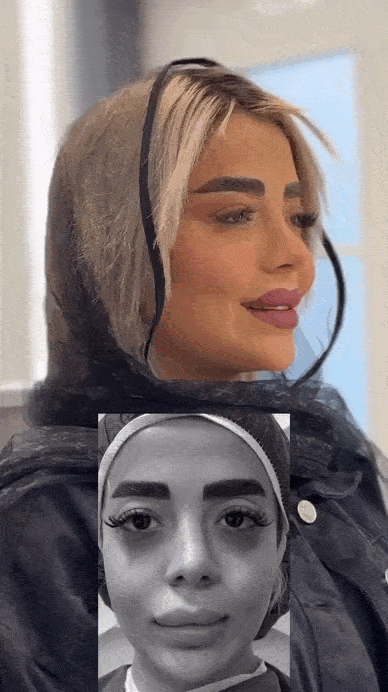 مراقبت های بعد از تزریق چربی به زیر چشم