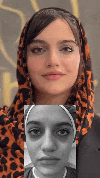 تزریق چربی برای حجیم کردن گونه و زاویه فک