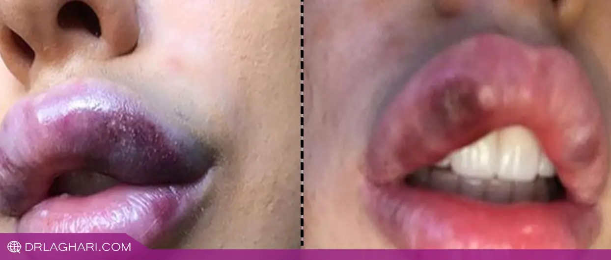 خطرات تزریق ژل ارزان چیست؟