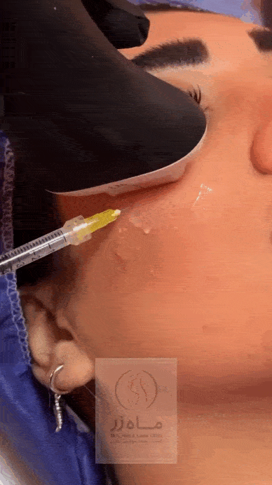 عوارض تزریق ژل نامرغوب