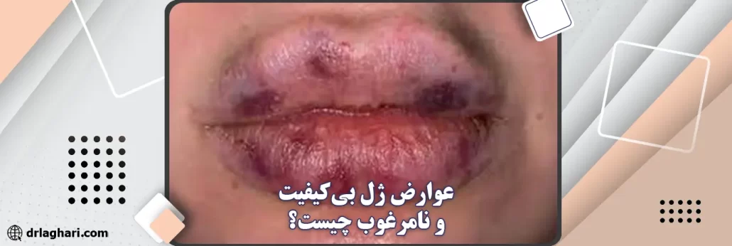 عوارض تزریق ژل نامرغوب