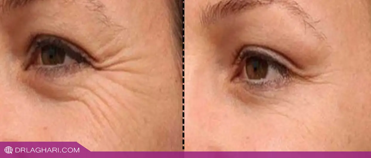 کدام روش برای تزریق زیر چشم بهتر است؟ تزریق چربی یا فیلر؟